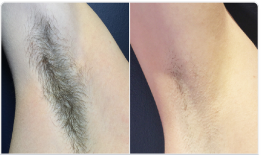 1800W diódalézeres szőrtelenítő készülék eredmény hónaj