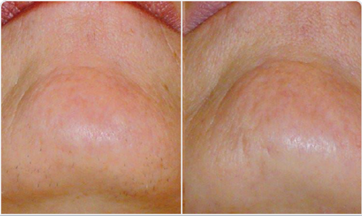 1800W diódalézeres szőrtelenítő készülék eredmény áll