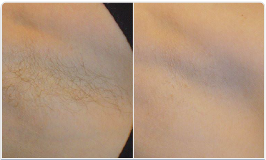 1800W diódalézeres szőrtelenítő készülék eredmény hónaj