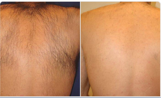 1800W diódalézeres szőrtelenítő készülék eredmény hát