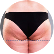 EMS testformáló kezelés előtti fenék állapot 2