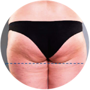 EMS testformáló kezelés utáni fenék állapot eredménye 2