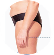 EMS testformáló kezelés előtti fenék állapot