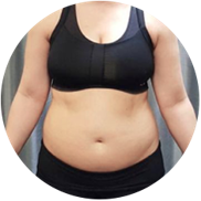 EMS testformáló kezelés előtti hasi állapot 4