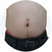 EMS testformáló kezelés előtti hasi állapot 3