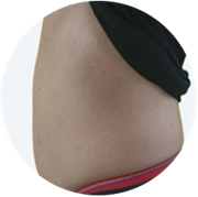 EMS testformáló kezelés előtti hasi állapot 2