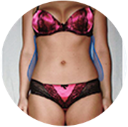 EMS testformáló kezelés utáni hasi állapot eredménye