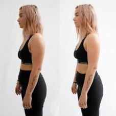 360 fokos krioliolízis CryoCool testformáló készülék zsírfagyasztás eredménye testformálás előtte utána kép