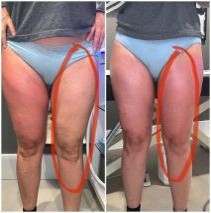 360 fokos krioliolízis CryoCool testformáló készülék zsírfagyasztás eredménye comb előtte utána kép