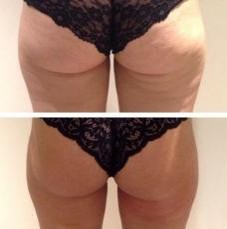 360 fokos krioliolízis CryoCool testformáló készülék zsírfagyasztás eredménye fenék előtte utána kép