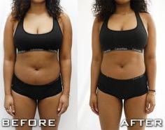 360 fokos krioliolízis CryoCool testformáló készülék zsírfagyasztás eredménye has előtte utána kép 2