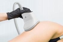 360 fokos krioliolízis CryoCool testformáló készülék zsírfagyasztó kezelőfej folyamat közben