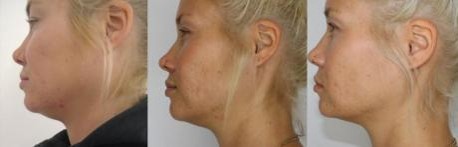 360 fokos krioliolízis CryoCool testformáló készülék zsírfagyasztás eredménye arc, toka előtte utána kép