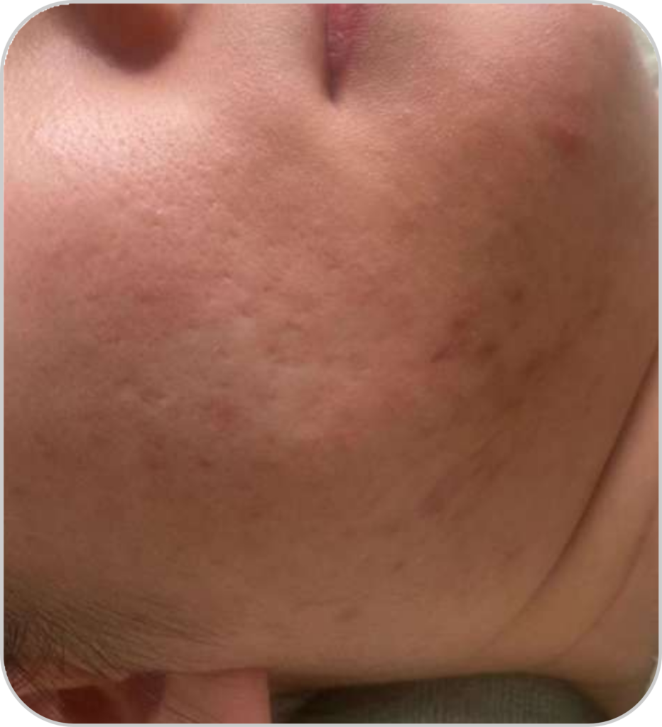 DPL plus szőrtelenítő, ér- és pigmentkezelő készülék akné kezelésének eredménye utána