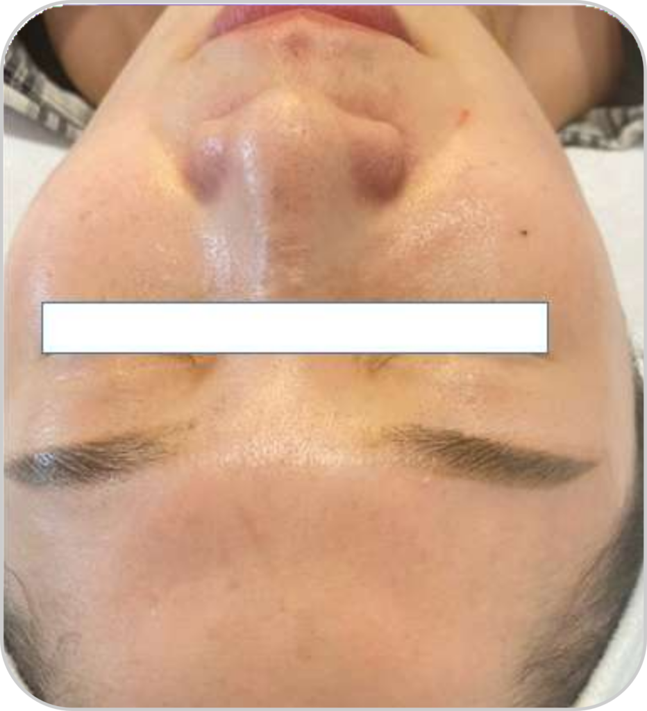 DPL plus szőrtelenítő, ér- és pigmentkezelő készülék pólus csökkentés kezelése előtt