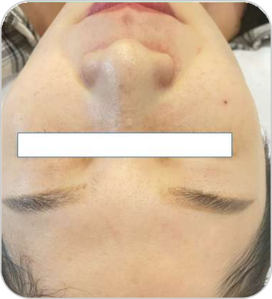 DPL plus szőrtelenítő, ér- és pigmentkezelő készülék pórus csökkentés kezelése eredménye utána