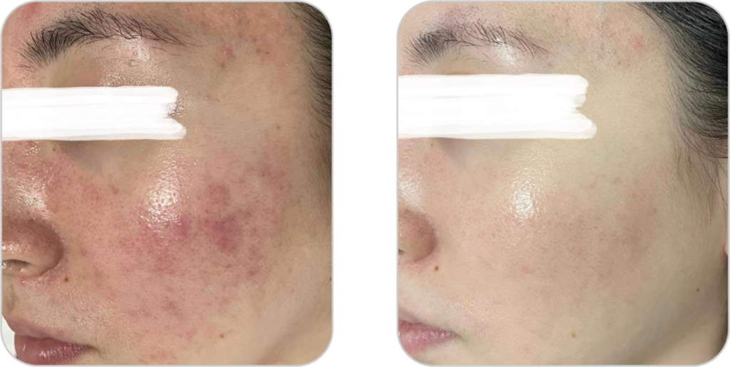 DPL plus szőrtelenítő, ér- és pigmentkezelő készülék rosacea kezelésének eredménye előtte-utána