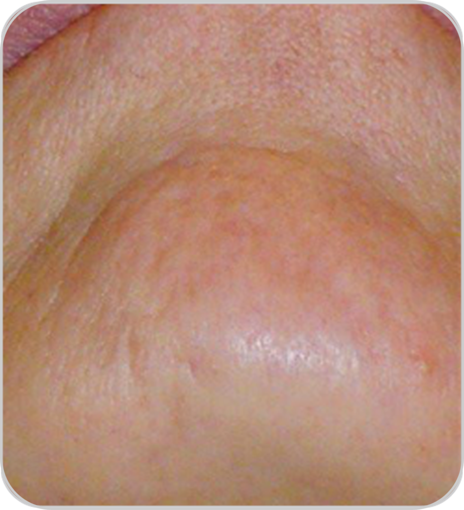 DPL plus szőrtelenítő, ér- és pigmentkezelő készülék áll szőrtelenítés után