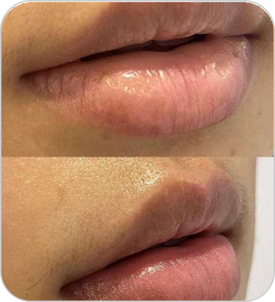 DPL plus szőrtelenítő, ér- és pigmentkezelő készülék üvegszáj kezelésének eredménye előtte