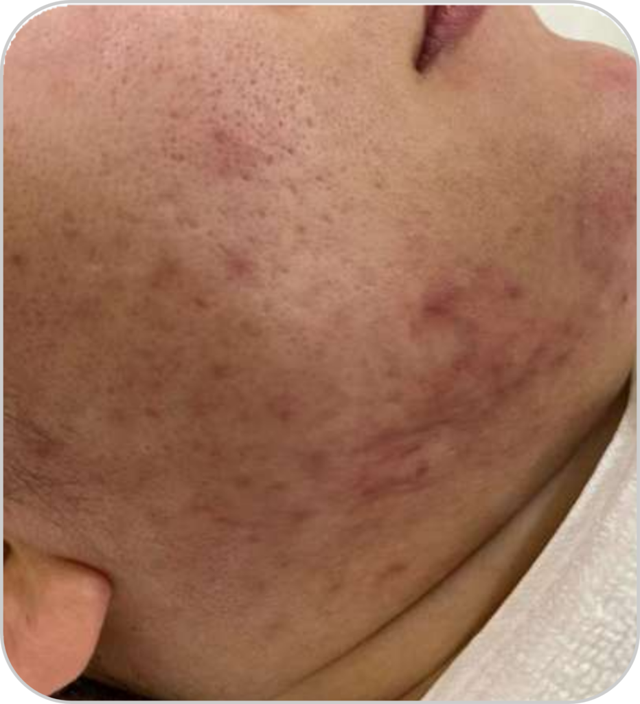 Pico lézer tetoválás és pimentfolt eltávolító és bőrfiatalító készülék akné kezelésének eredmény előtte