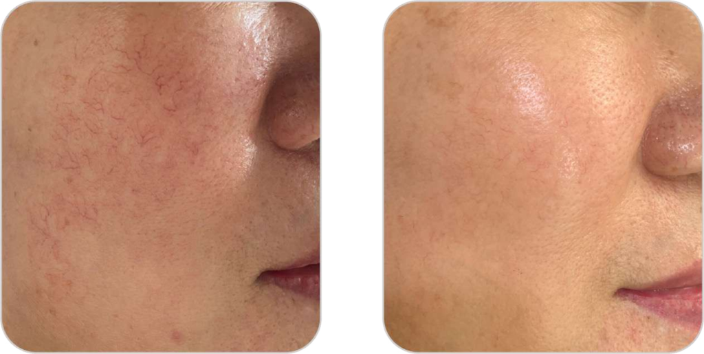 Pico lézer tetoválás és pimentfolt eltávolító és bőrfiatalító készülék érkezelésének eredmény előtte-utána