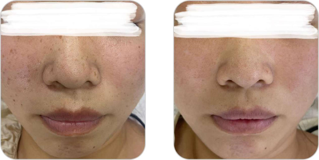 Pico lézer tetoválás és pimentfolt eltávolító és bőrfiatalító készülék szeplők kezelésének eredmény előtte-utána