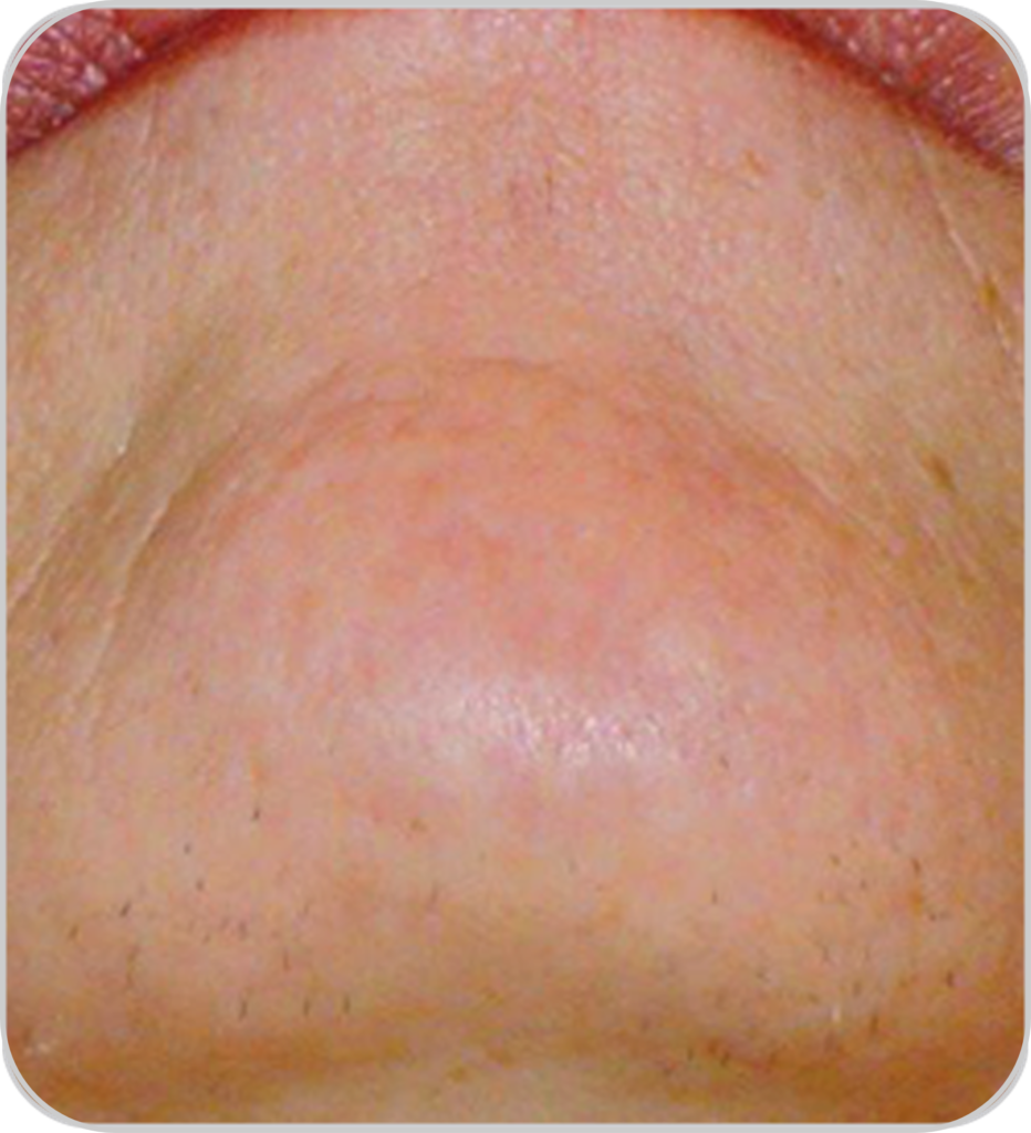 Pico lézer tetoválás és pimentfolt eltávolító és bőrfiatalító készülék szőrtelenítés áll esetében az eredmény előtt