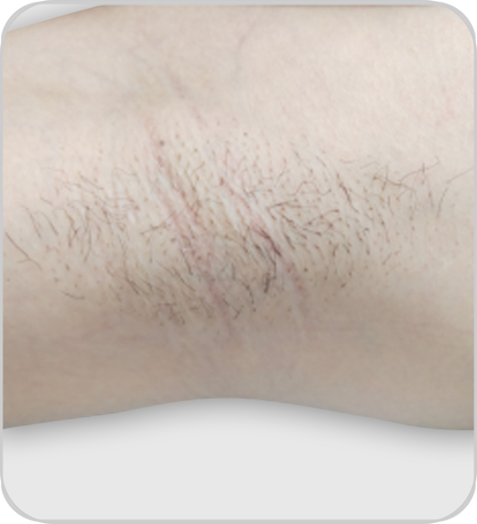 Pico lézer tetoválás és pimentfolt eltávolító és bőrfiatalító készülék szőrtelenítés eredmenye előtte