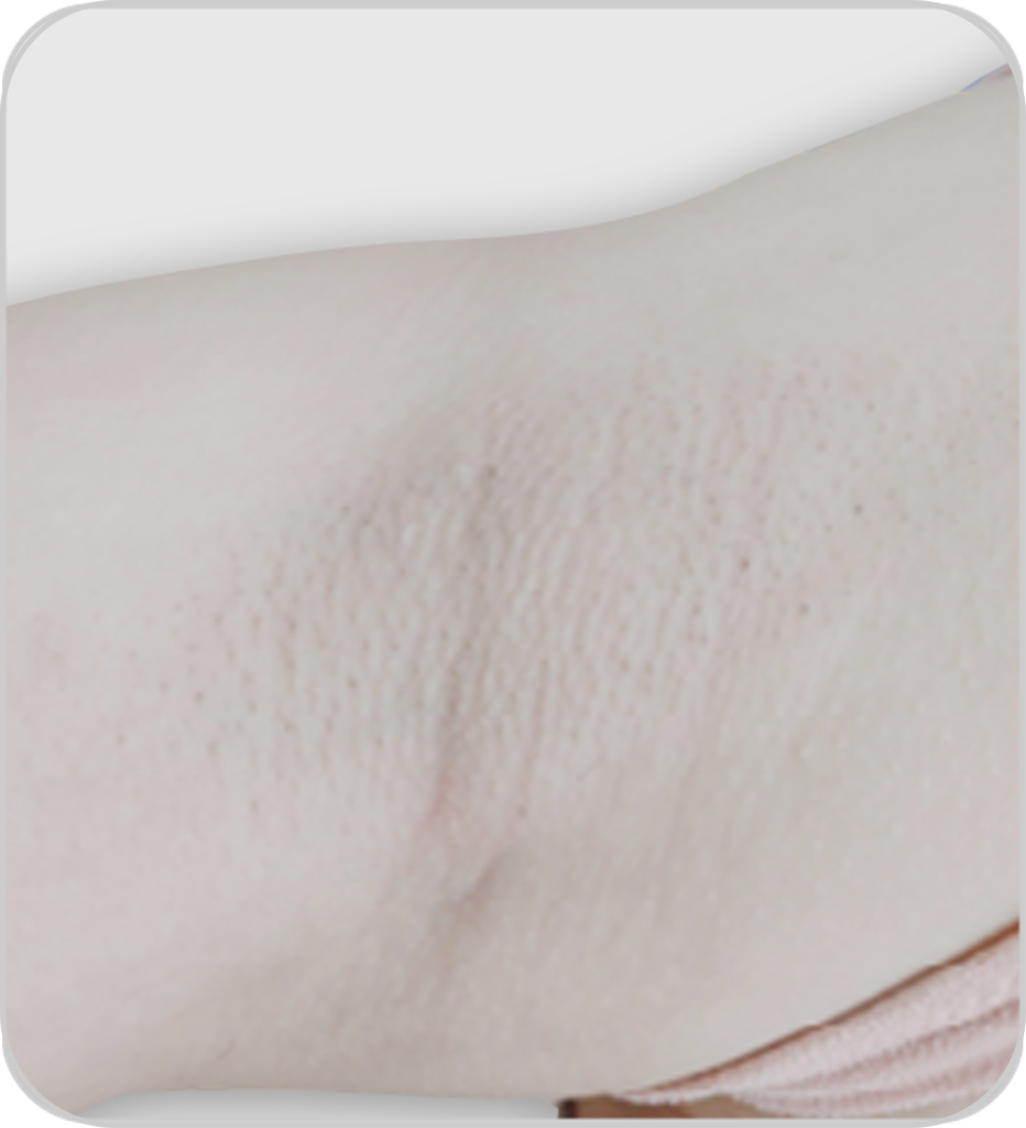 Pico lézer tetoválás és pimentfolt eltávolító és bőrfiatalító készülék szőrtelenítés eredmenye utána