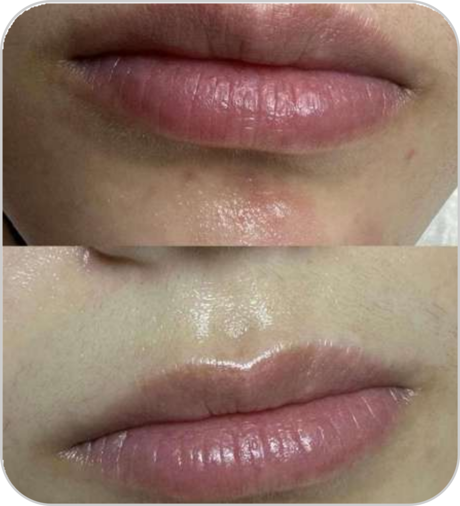 Pico lézer tetoválás és pimentfolt eltávolító és bőrfiatalító készülék üvegszáj kezelésének eredmény utána