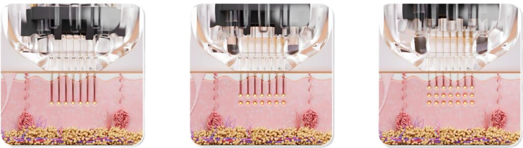 PatrixR mikrotűs RF bőrfeszesítő és frakcinált rádiófrekvenciás kezelőgép 3in1 technoloógiája