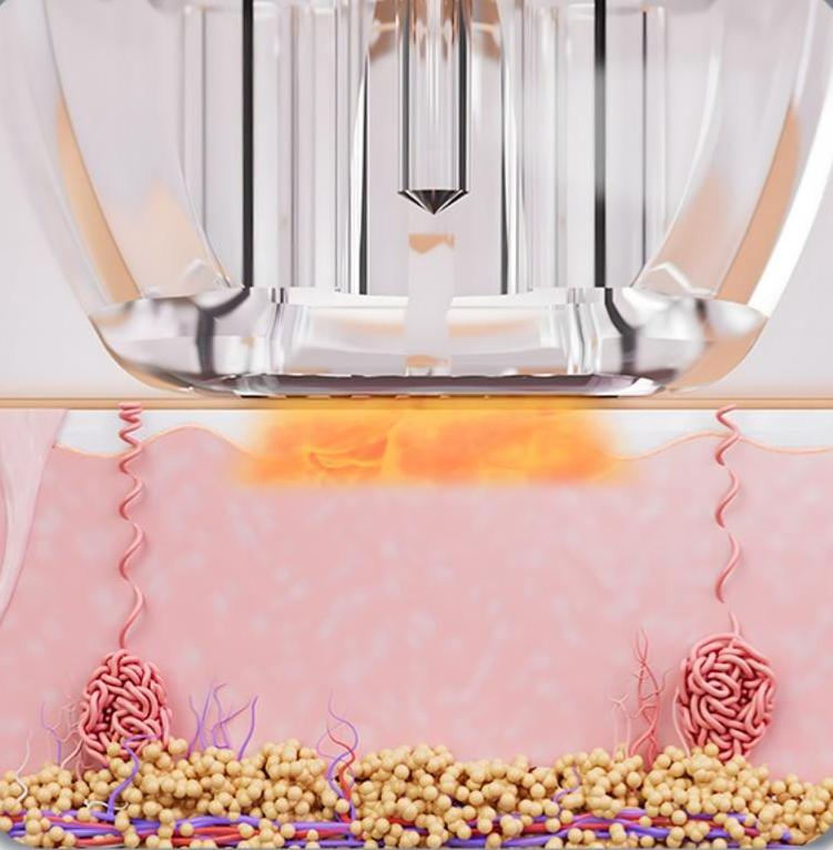 PatrixR mikrotűs RF bőrfeszesítő és frakcinált rádiófrekvenciás kezelőgép kezelési folyamata