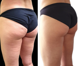 Megashape Pro kezelés előtte–utána eredmény: feszesebb bőr és csökkent narancsbőr a comb–fenék területén