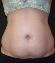 Megashape Pro kezelés előtti has állapota – laza bőr és lokális zsírpárnák