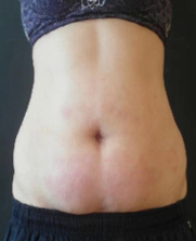 Megashape Pro kezelés utáni has – feszesebb bőr és csökkent hasi körfogat